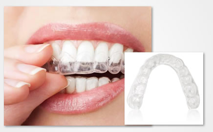 Clear Aligner System